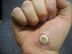 Slideshow: Blisters Causes and Treatment - WebMD