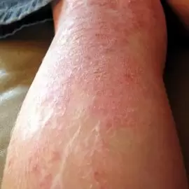 atopowe zapalenie skóry