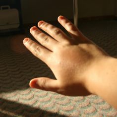 ostra pokrzywka alergiczna