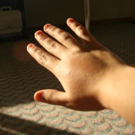 ostra pokrzywka alergiczna