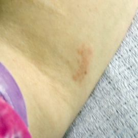 pokrzywka alergiczna