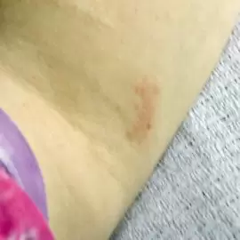 pokrzywka alergiczna