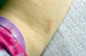 pokrzywka alergiczna