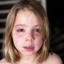 pokrzywka barwnikowa