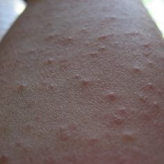 pokrzywka kontaktowa