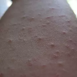 pokrzywka kontaktowa