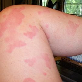 przewlekła pokrzywka alergiczna