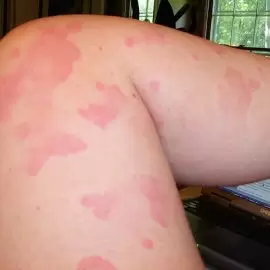 przewlekła pokrzywka alergiczna