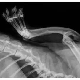 Hemimelia promieniowa