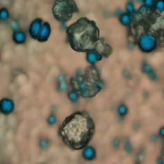 Neurofibomatoza - nerwiakowłókniakowatość