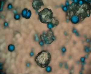 Neurofibomatoza - nerwiakowłókniakowatość