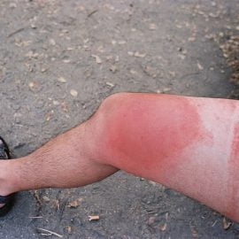 Wstrząs anafilaktyczny