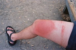 Wstrząs anafilaktyczny