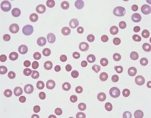 Zespół TAR (Zespół małopłytkowości)