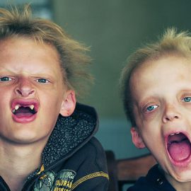 Dysplazja ektodermalna