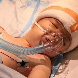 Stwardnienie guzowate