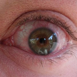 Alergiczne zapalenie spojówek