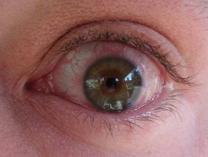 Alergiczne zapalenie spojówek