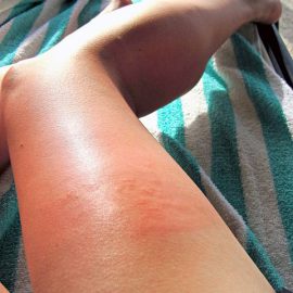 wstrząs anafilaktyczny