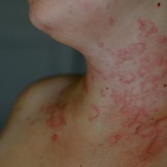 obrzęk naczynioruchowy