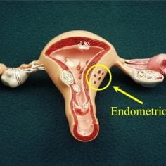 Kłopoty z endometrium