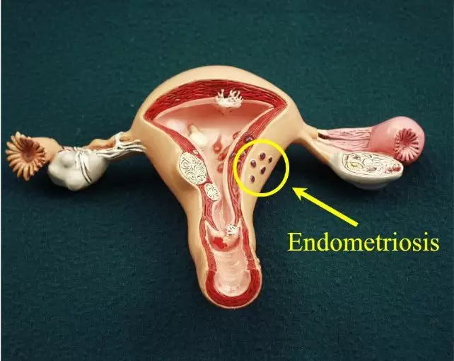 Kłopoty z endometrium