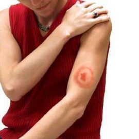 Borelioza przewlekła