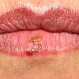 Opryszczka wargowa