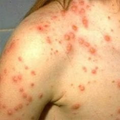ospa