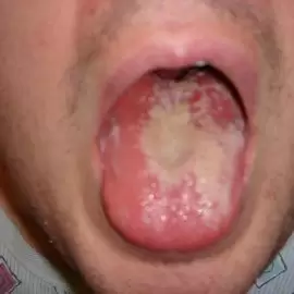 Pleśniawki u dorosłych