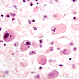 Cytomegalia