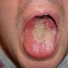 Drożdżyca (kandydoza)