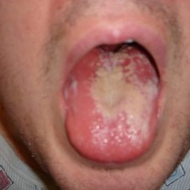 Drożdżyca (kandydoza)