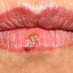 Opryszczka a słońce