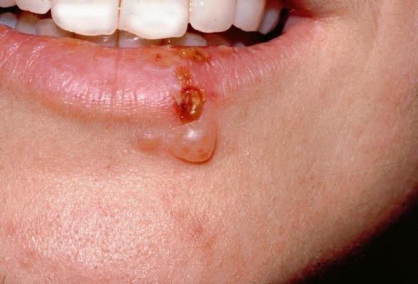 Opryszczka błony śluzowej jamy ustnej i gardła