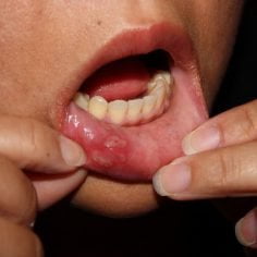 Opryszczka jamy ustnej