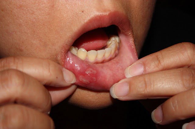 Opryszczka jamy ustnej