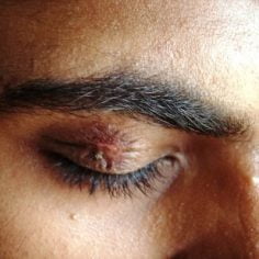 Opryszczka narządu wzroku