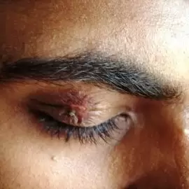 Opryszczka narządu wzroku