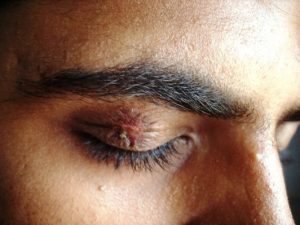 Opryszczka narządu wzroku