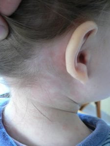 Różyczka u dorosłych