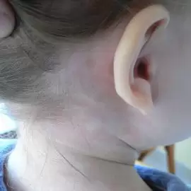 Różyczka u dorosłych