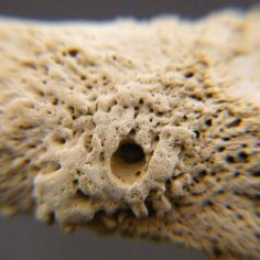 Zapalenie szpiku kostnego