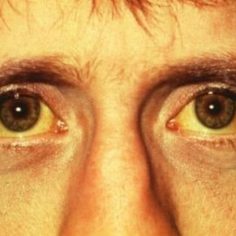 Żółtaczka pokarmowa