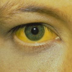 Żółtaczka wszczepienna