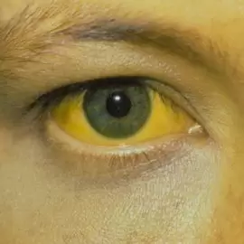 Żółtaczka wszczepienna