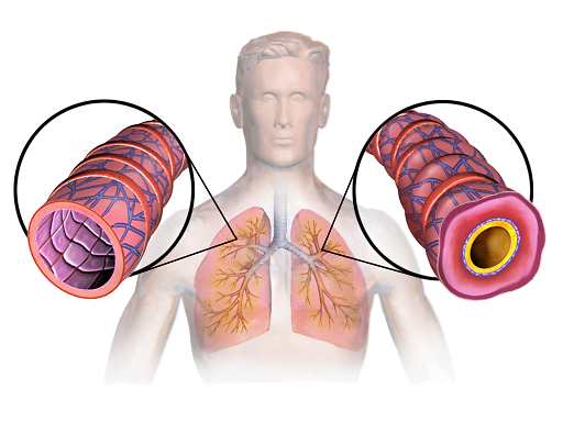 Domowy sposób na astmę