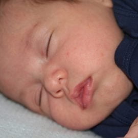 Częściowa trisomia ramienia długiego chromosomu 11