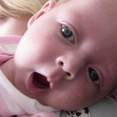 Trisomia chromosomu 15