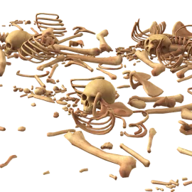 Dysplazja włóknista kości